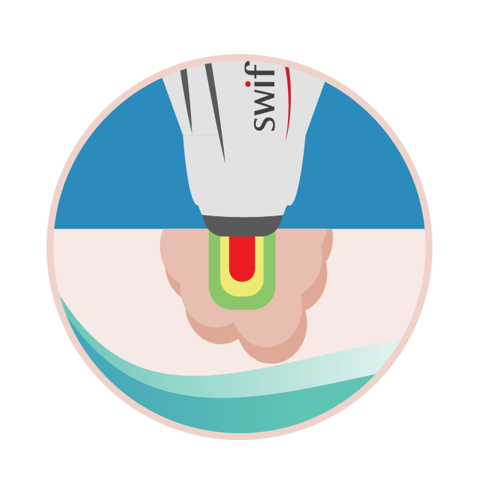 Illustration of the Swift probe heating a verruca